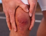 4135 Хондромаляция надколінка, що це таке – хондроз колінного суглоба лікування